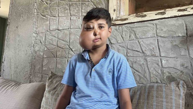 İki farklı yüzü var gibi görünen çocuğun tek isteği iyileşip gülmek