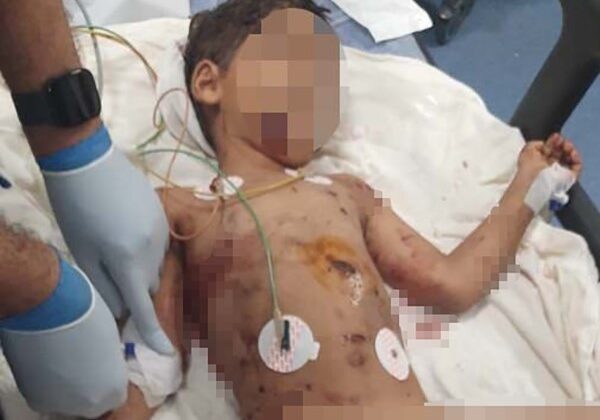 Sokak köpeklerinin saldırdığı 5 yaşındaki Abbas ağır yaralandı