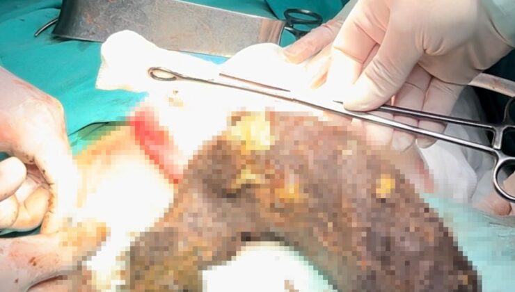 15 yıldır saç yeme alışkanlığı olan genç kızın karnından 2 kilogram kıl yumağı çıktı
