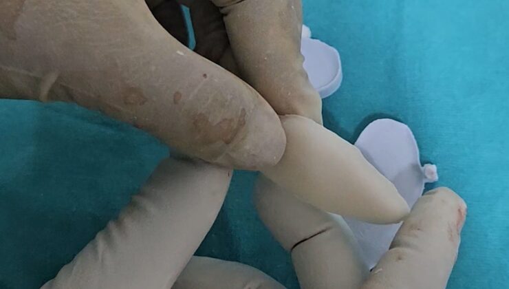 Osmaniye’de ilk kez 3D yazıcı tekniğiyle kafatası ameliyatı