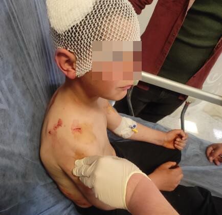 Isparta’da sokakta oynayan çocuğa başıboş köpek saldırdı