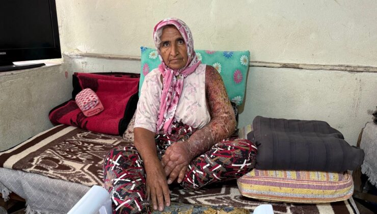 Kolu şişti, vücuduna kadar yara oldu: 4 çocuk annesinin zorlu yaşamı